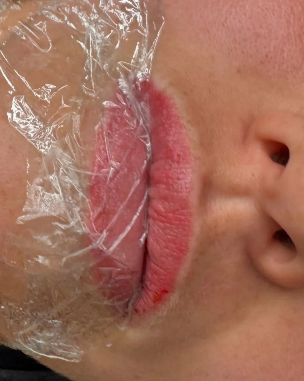 Saline Tattoo Removal, A Non-Laser Option