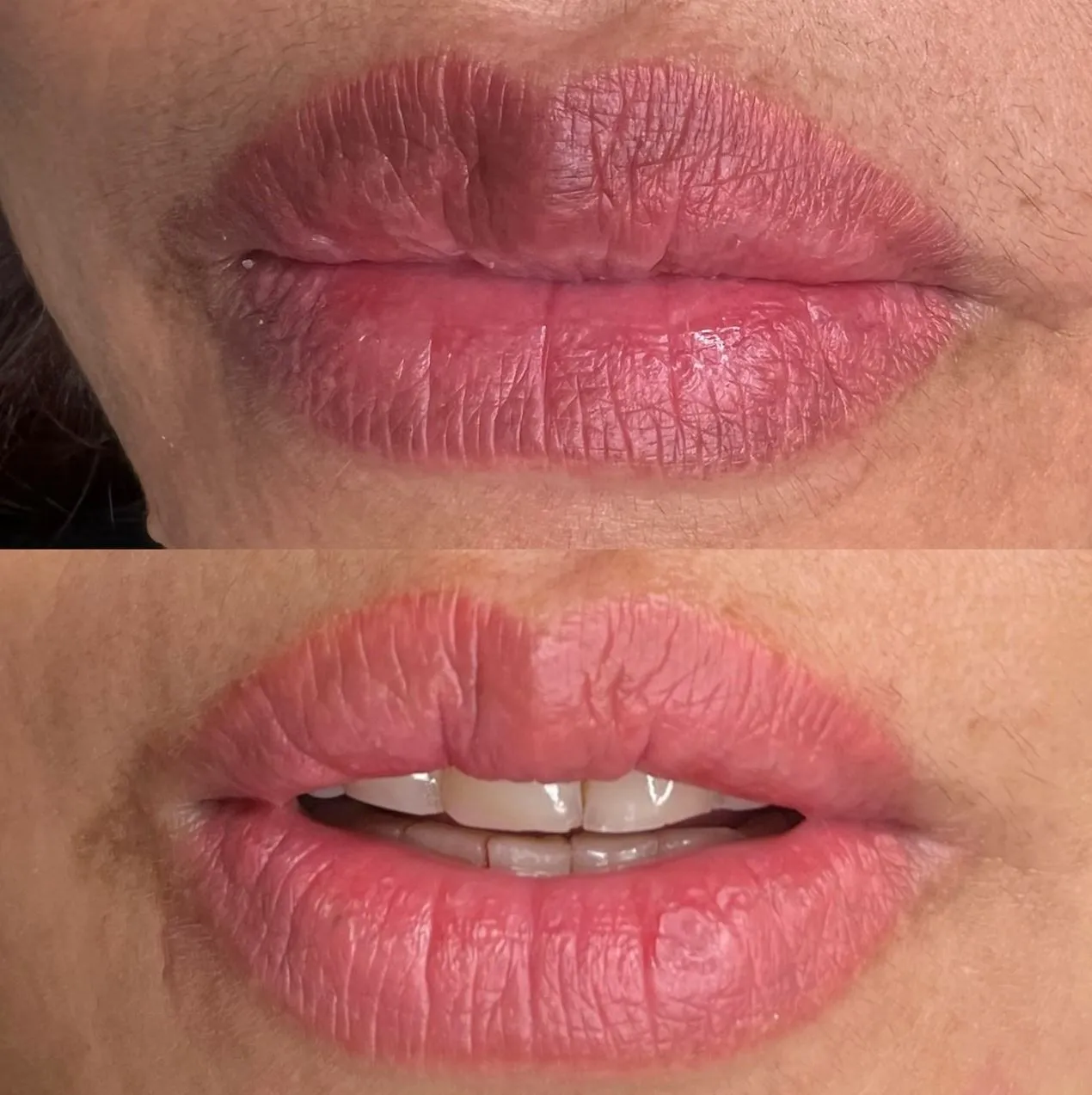 Why Remove a Lip Tattoo
