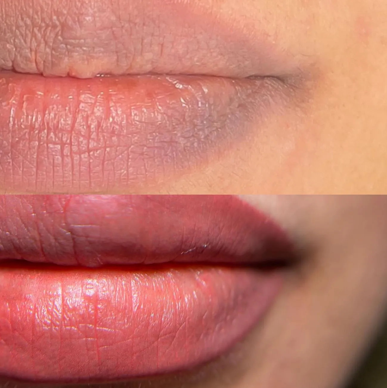 lip neutralization